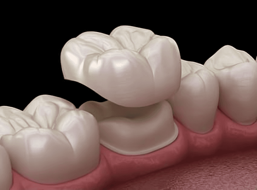 Zirconia Crowns