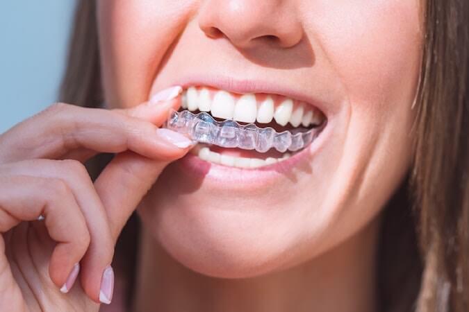 Invisible Orthodontics