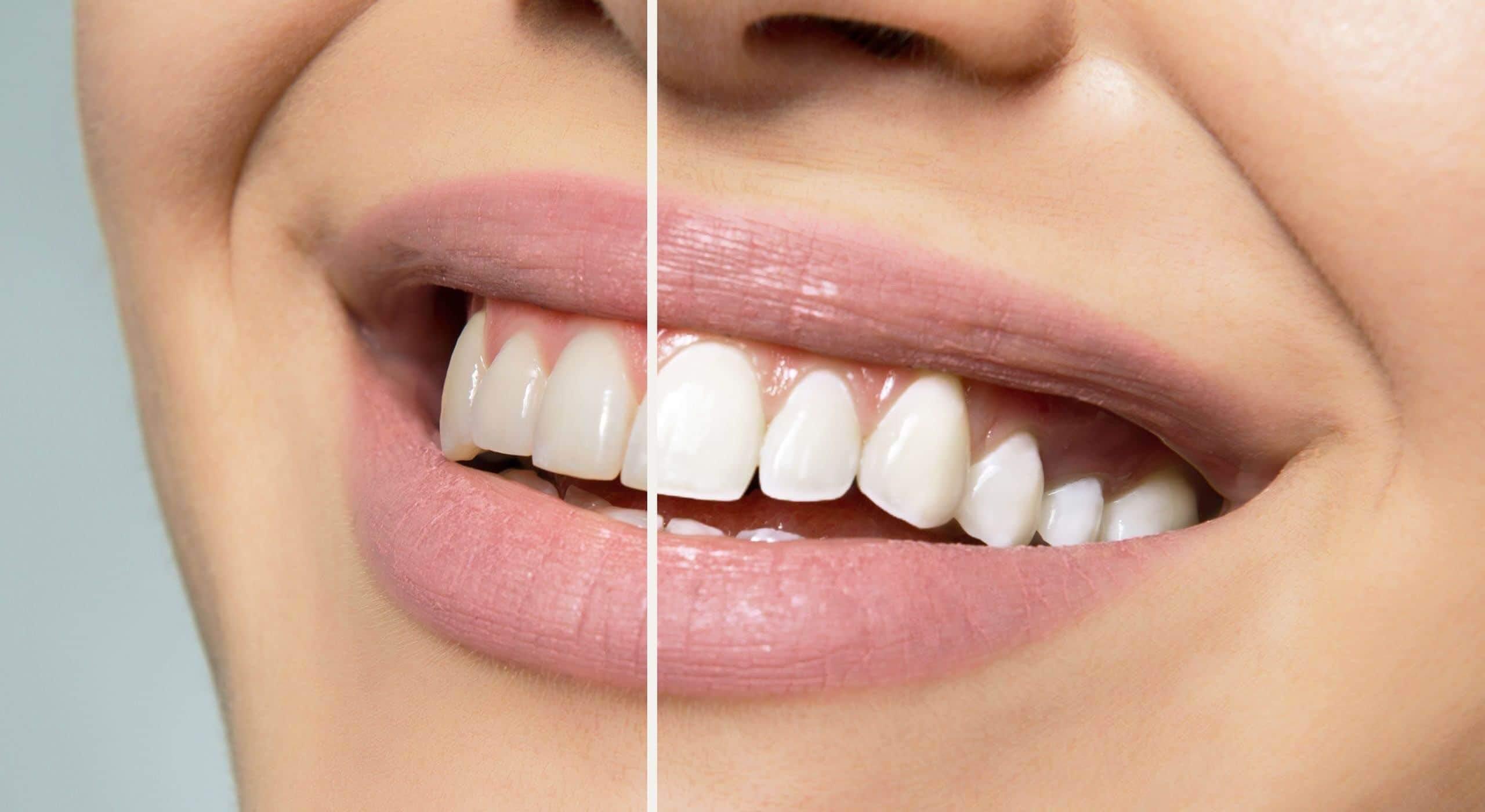 Teeth Whitening