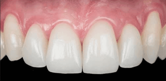 Dental restoration with composite