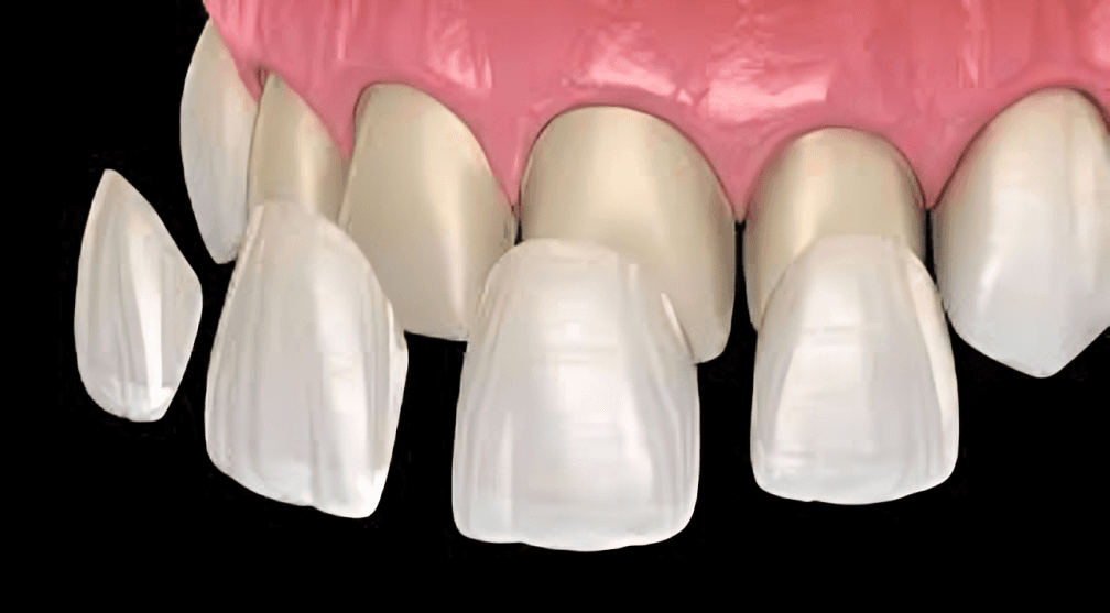 Ceramic veneers