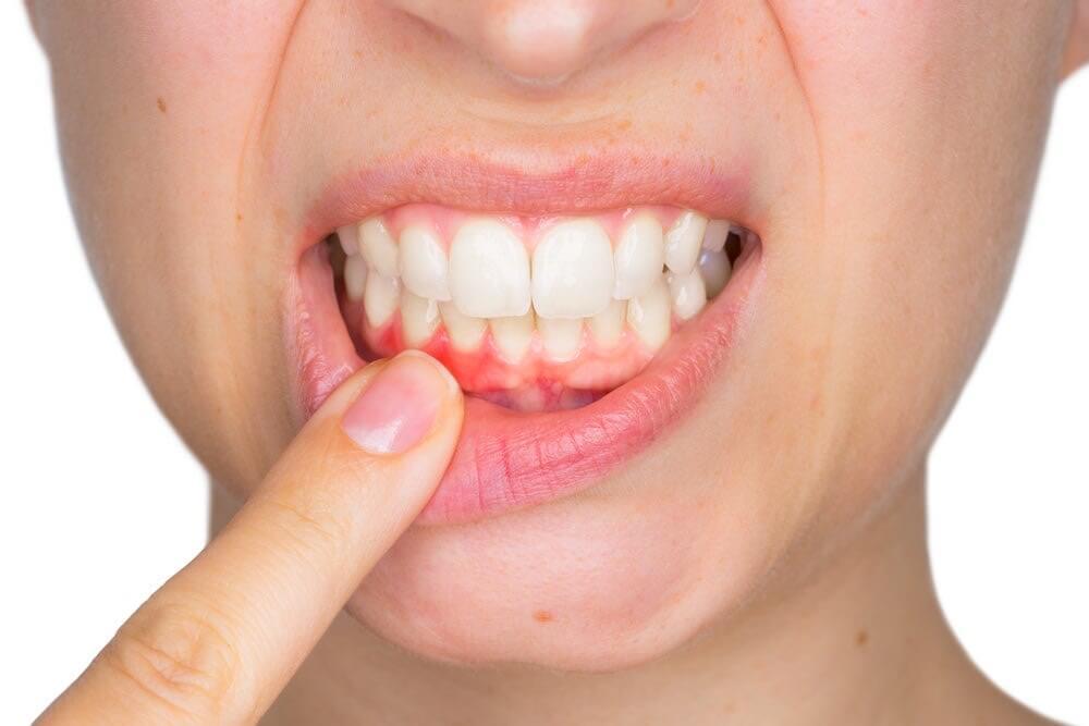 Treatment of Gingivitis and Periodontitis